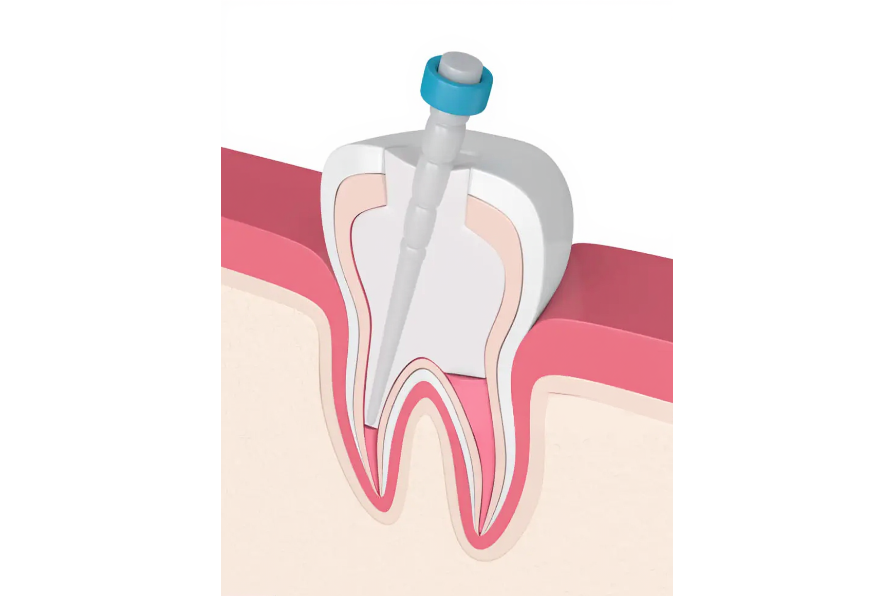 Root Canal Treatment