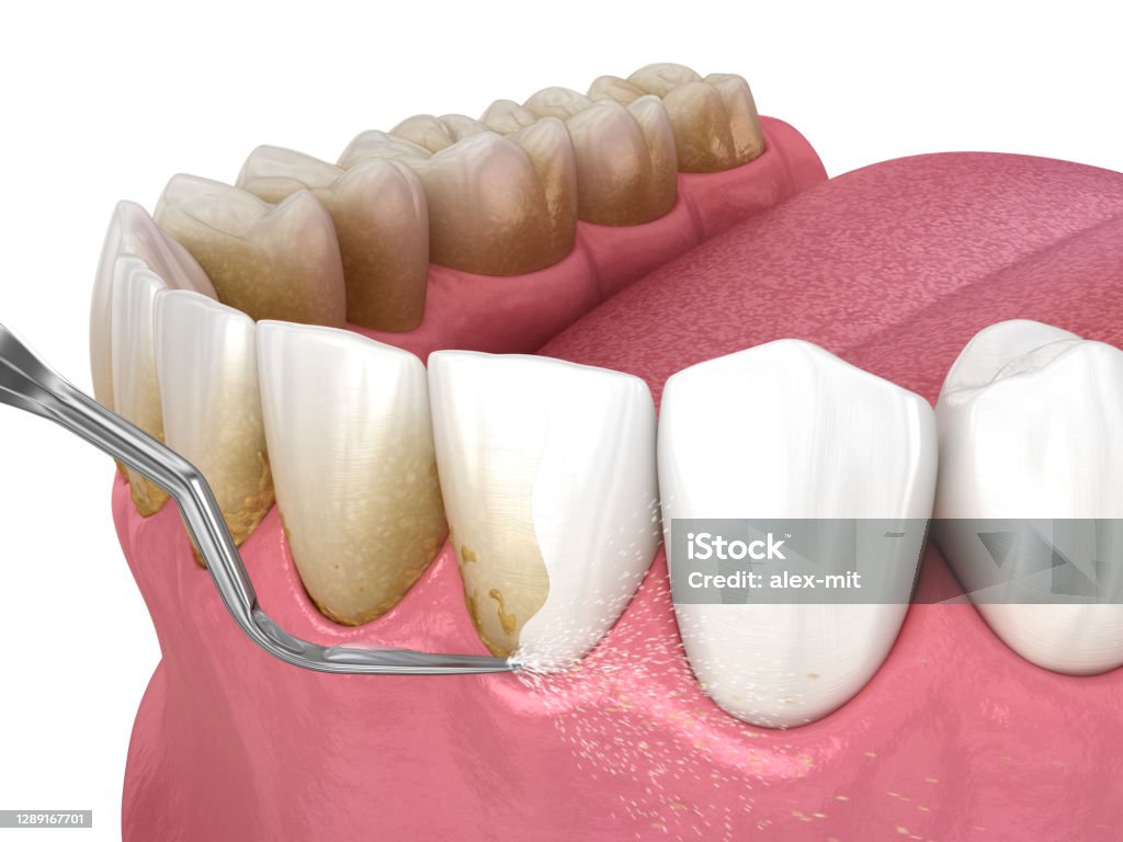 Scaling and Polishing