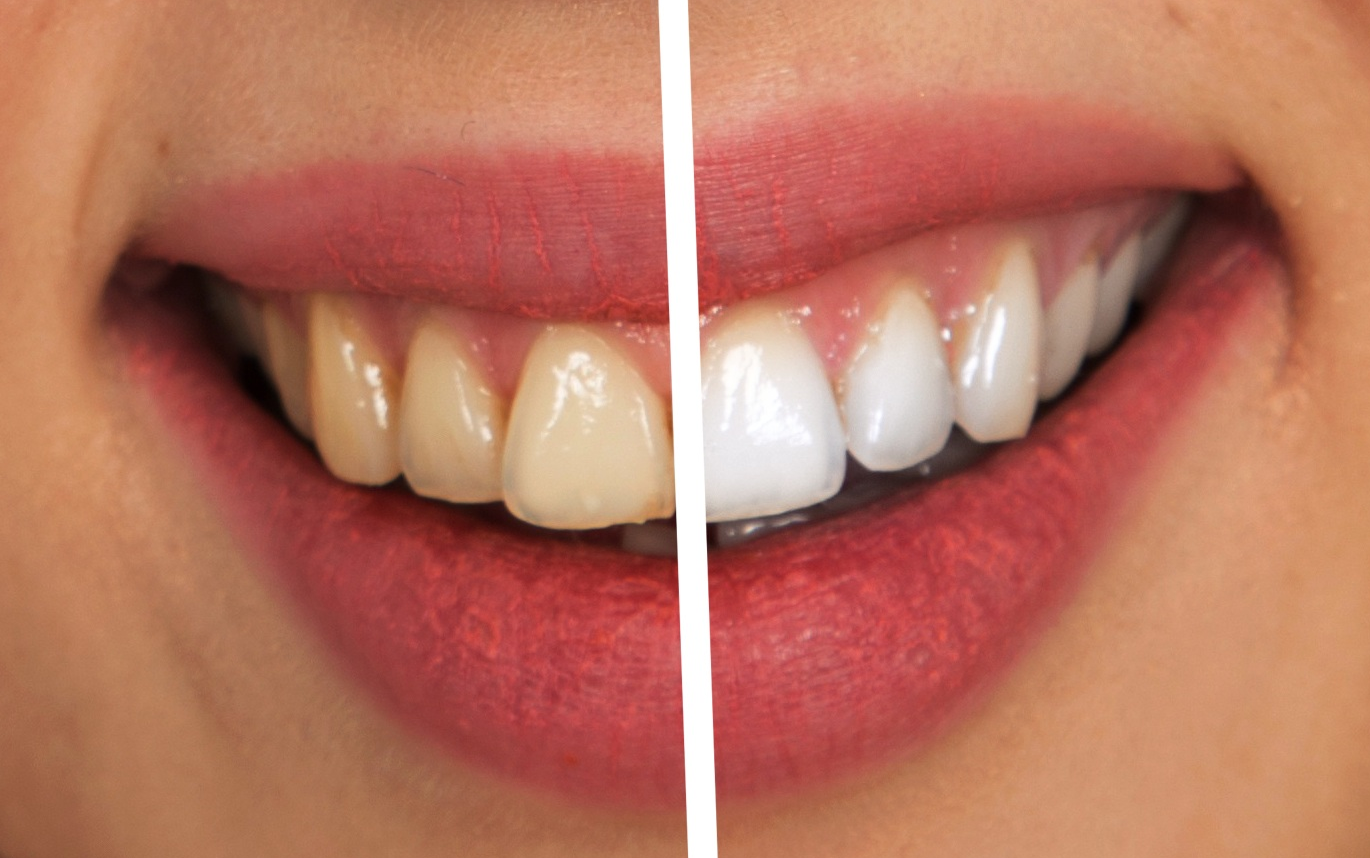 Teeth Whitening