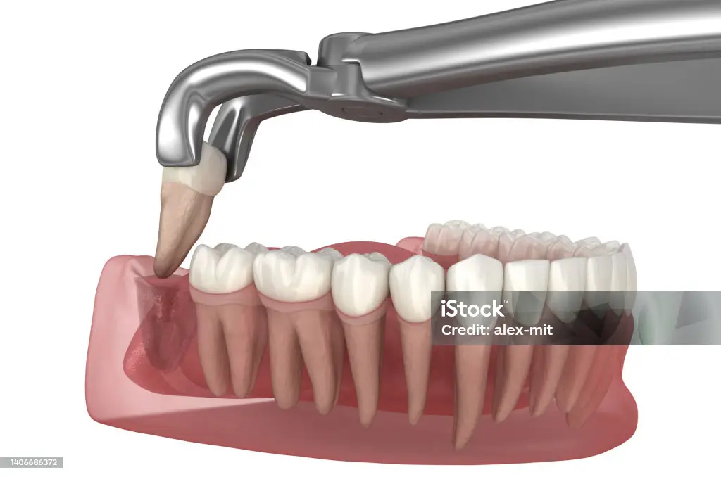 Wisdom Tooth Extractions